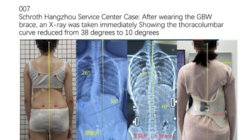 هل حزام اعوجاج العمود الفقري يستحق التكلفة؟ مقارنة الحزام بالمراقبة ونتائج المدى الطويل