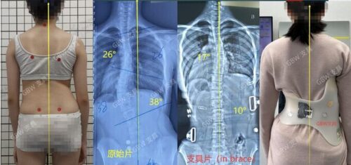 أسباب تردد الأهل قبل بدء العلاج بحزام اعوجاج العمود الفقري