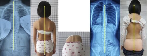 متى تظهر زيادة الطول بعد علاج اعوجاج العمود الفقري؟