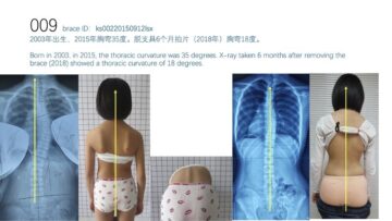 تطور اعوجاج العمود الفقري خلال البلوغ: متى يزيد الخطر؟ ومتى يصبح الحزام ضروريًا؟