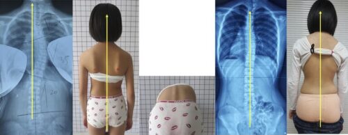أهمية تخصيص علاج اعوجاج العمود الفقري لكل مريض