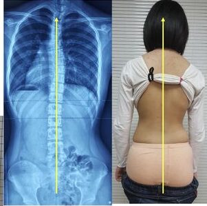 تطور اعوجاج العمود الفقري خلال البلوغ: متى يزيد الخطر؟ ومتى يصبح الحزام ضروريًا؟