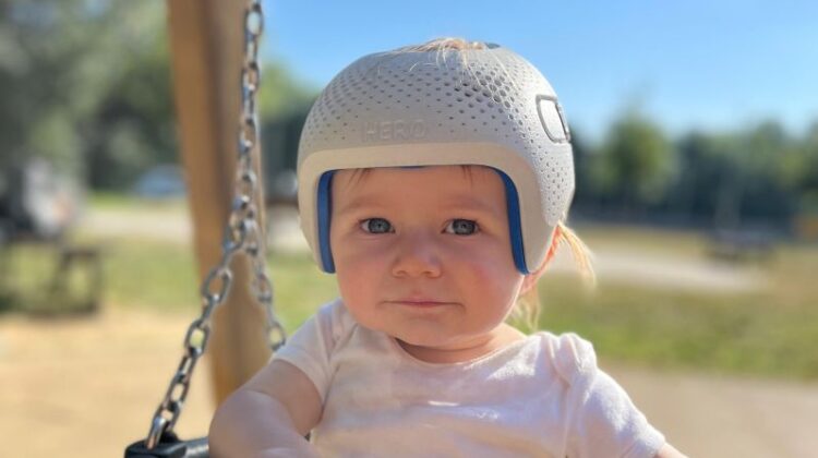 المدة المثالية لاستخدام خوذة الرأس بعد جراحة التحام الدروز السهمية عند الأطفال