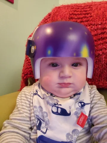 كم من الوقت يستغرق قياس وتصنيع خوذة علاج الرأس المسطح للأطفال؟ دليل الأهل خطوة بخطوة