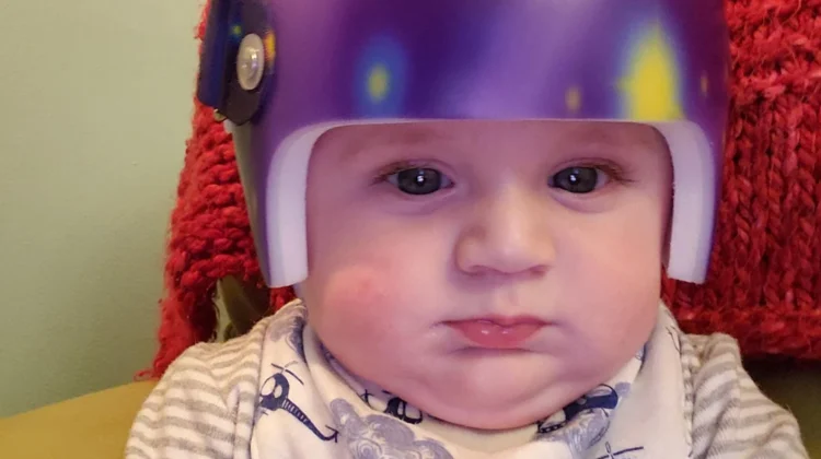 كم من الوقت يستغرق قياس وتصنيع خوذة علاج الرأس المسطح للأطفال؟ دليل الأهل خطوة بخطوة