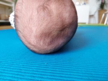 تسطح الرأس عند الرضع: الفرق بين التسطح الجانبي والخلفي وما الذي يجب فعله