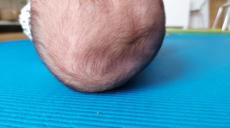 تسطح الرأس عند الرضع: الفرق بين التسطح الجانبي والخلفي وما الذي يجب فعله