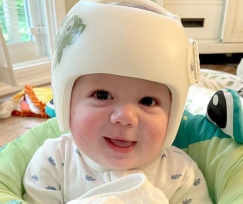 هل يمكن لخوذة علاج الرأس المسطح تصحيح بروز الجبهة وموقع الأذن عند الأطفال؟