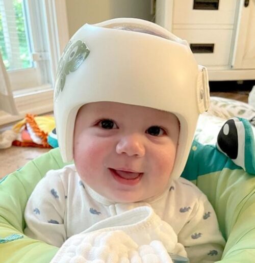 هل يمكن لخوذة علاج الرأس المسطح تصحيح بروز الجبهة وموقع الأذن عند الأطفال؟