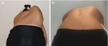 العلاقة بين حجم تحدب الظهر وشدة اعوجاج العمود الفقري: دراسة طبية مبسطة