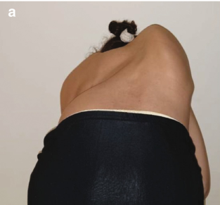 العلاقة بين حجم تحدب الظهر وشدة اعوجاج العمود الفقري: دراسة طبية مبسطة