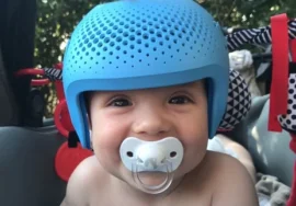 خوذة تسطح الرأس للرضع المصابين بمرض تكسّر العظام الخِلقي : فوائد ونتائج