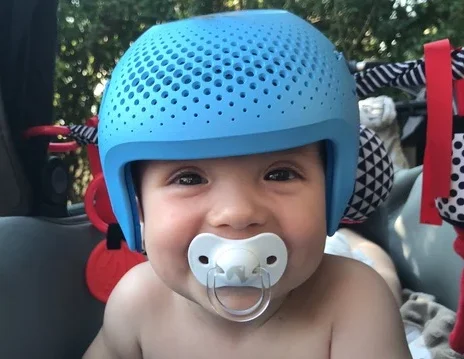 خوذة تسطح الرأس للرضع المصابين بمرض تكسّر العظام الخِلقي : فوائد ونتائج