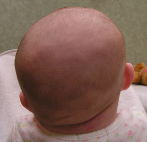 تشوّهات الرأس الشائعة عند الأطفال: الأنواع، الأسباب، والعلاج المبكر