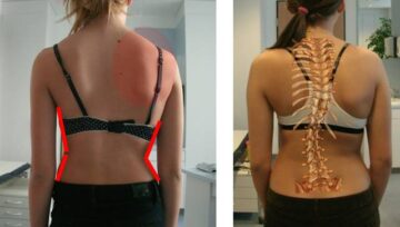 ما هي أسباب اعوجاج العمود الفقري عند النساء؟ تعرفي على العوامل وكيفية الوقاية