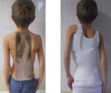 تجربة حزام اعوجاج العمود الفقري: العوامل التي تجعل العلاج غير مريح وكيفية تحسين راحة طفلك