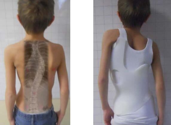 تجربة حزام اعوجاج العمود الفقري: العوامل التي تجعل العلاج غير مريح وكيفية تحسين راحة طفلك