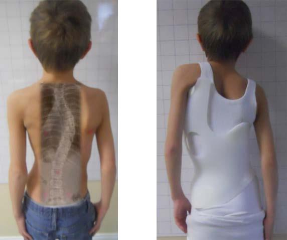 تجربة حزام اعوجاج العمود الفقري: العوامل التي تجعل العلاج غير مريح وكيفية تحسين راحة طفلك