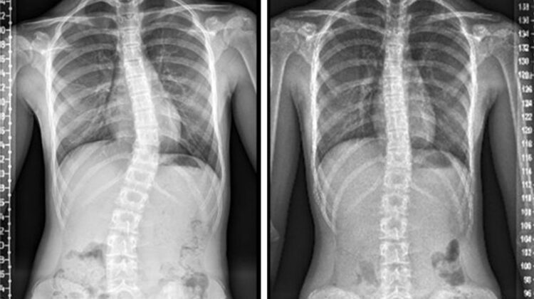 هل يمكن علاج الجنف بدون عملية؟ طرق فعّالة لتقويم العمود الفقري وتحسين القامة