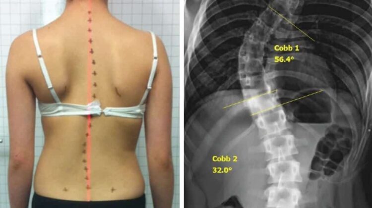 كيف أعرف أن ظهري معوج؟ دليل مبسّط للأهل والمرضى لاكتشاف اعوجاج العمود الفقري مبكرًا