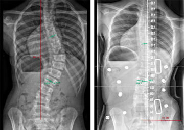 اعوجاج العمود الفقري: كيف يتم تخصيص العلاج لكل مريض لتحقيق أفضل النتائج