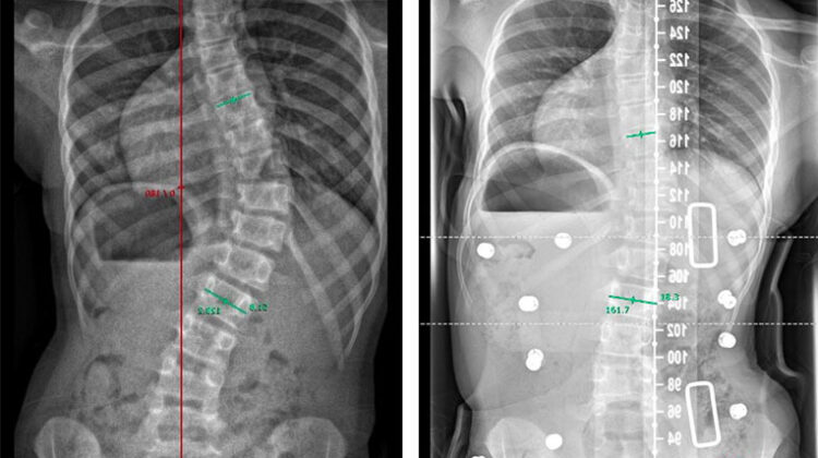 اعوجاج العمود الفقري: كيف يتم تخصيص العلاج لكل مريض لتحقيق أفضل النتائج