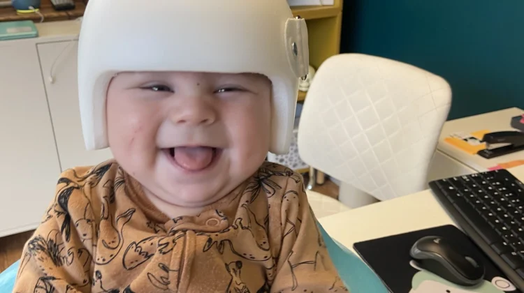 الخوذة أم الجراحة لعلاج الرأس المسطّح: كيف تؤثر كل طريقة على طفلك ونتائجه الصحية؟