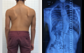 ماذا تفعل إذا لم يكن عمودك الفقري مستقيماً؟ خطوات عملية للتشخيص والعلاج