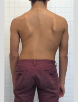 ماذا تفعل إذا لم يكن عمودك الفقري مستقيماً؟ خطوات عملية للتشخيص والعلاج