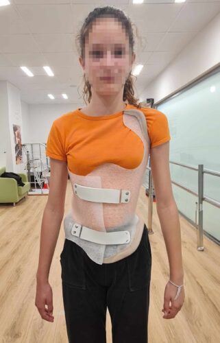 لماذا يفشل بعض الأطفال في الالتزام بارتداء حزام اعوجاج العمود الفقري؟