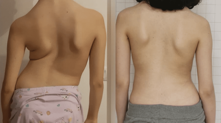 كيف تجعل عمودك الفقري مستقيمًا بسهولة؟ دليلك لتحسين وضعية الظهر والوقاية من مشكلات العمود الفقري