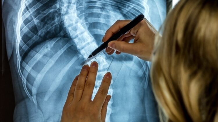 اعوجاج العمود الفقري: أسئلة شائعة وإجابات طبية تطمئن الأهل والمرضى