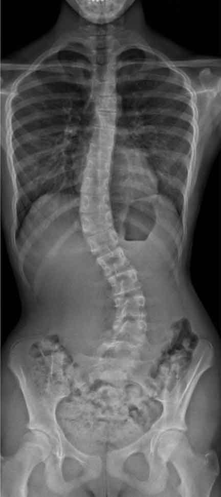 هل يختفي اعوجاج العمود الفقري من تلقاء نفسه؟ | الحقيقة الطبية للأهل والمرضى