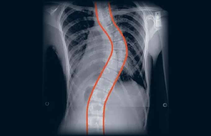 هل سيتطور اعوجاج العمود الفقري خلال سن البلوغ؟ وكيف تتعامل معه بذكاء؟