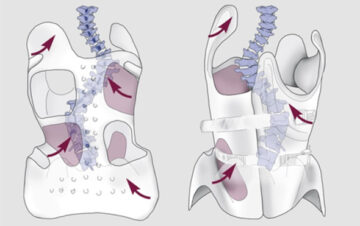 حزام الظهر الطبي لعلاج انحناء العمود الفقري: كيف يساعد طفلك ويمنع تفاقم الانحناء