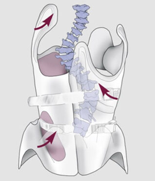 حزام الظهر الطبي لعلاج انحناء العمود الفقري: كيف يساعد طفلك ويمنع تفاقم الانحناء