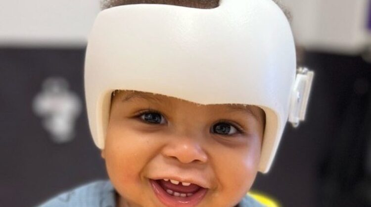 تناسق الجمجمة والوجه بعد العلاج بالخوذة : تحليل ثلاثي الأبعاد يكشف النتائج