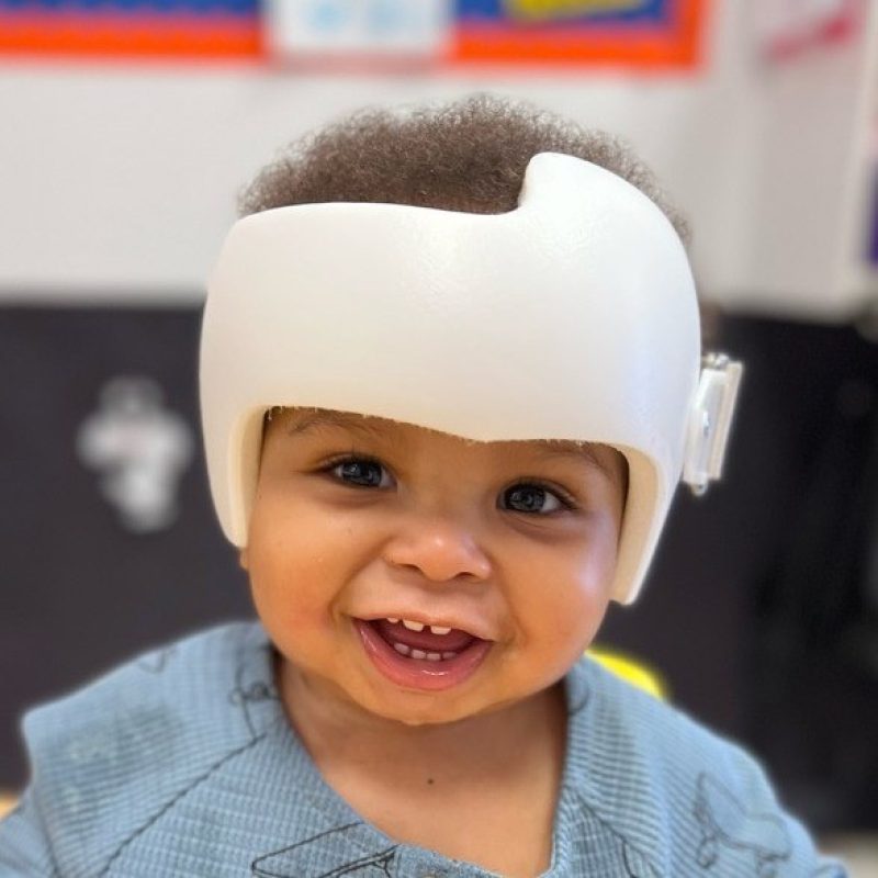 تناسق الجمجمة والوجه بعد العلاج بالخوذة : تحليل ثلاثي الأبعاد يكشف النتائج