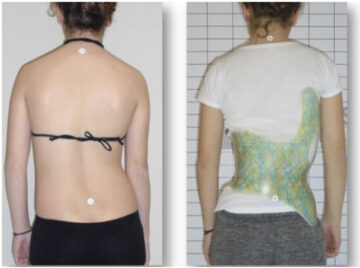 هل يُحسّن حزام اعوجاج العمود الفقري شكل الظهر والجذع؟ تعرف على النتائج التي سيلاحظها طفلك