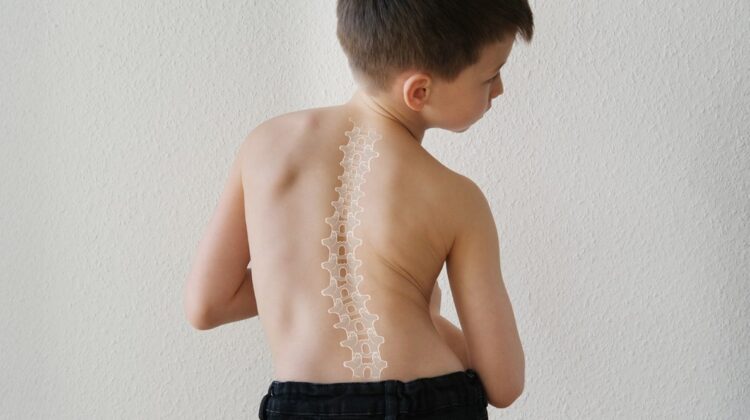 هل يمكن علاج الجنف عند الأطفال بالتمارين الرياضية؟ دليلك لتقليل الانحناء