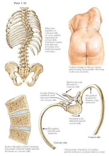قياس دوران الفقرات لتقييم اعوجاج العمود الفقري : كيف يساعدك الذكاء الاصطناعي