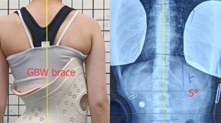 حزام اعوجاج العمود الفقري لماذا يتردد الأهل قبل استخدامة وكيف تتخذ قرارك بثقة؟