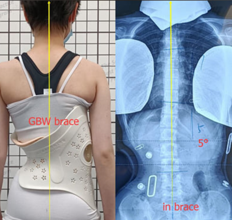 حزام اعوجاج العمود الفقري لماذا يتردد الأهل قبل استخدامة وكيف تتخذ قرارك بثقة؟