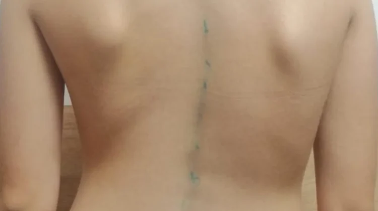 مالذي يشعر به مريض اعوجاج العمود الفقري؟ | دليلك لفهم الأعراض والتعامل معها