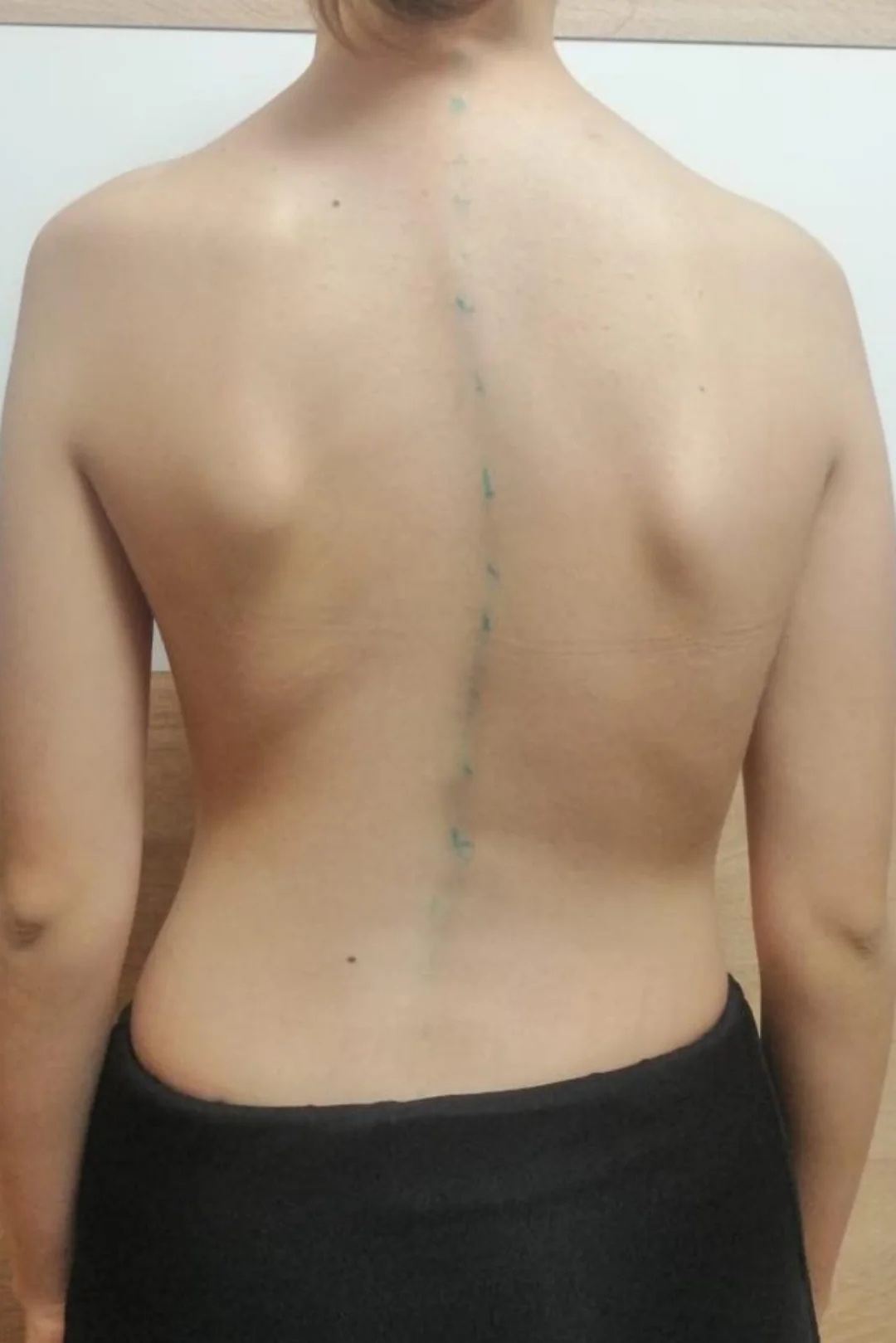 مالذي يشعر به مريض اعوجاج العمود الفقري؟ | دليلك لفهم الأعراض والتعامل معها