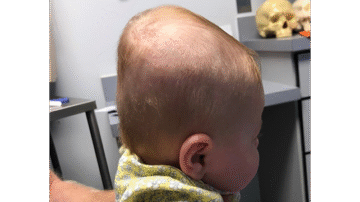 نظرة المجتمع للطفل المصاب بالرأس المسطح : كيف يتعامل معه المجتمع بسخرية واستهزاء