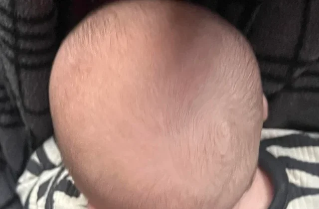 تشوّه الرأس عند الأطفال: مخاوف الأمهات وكيفية التعامل بذكاء