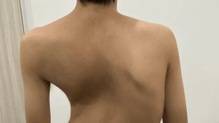 لماذا أصبح عمودي طفلي الفقري معوجًا فجأة؟ أسباب طبية، علامات تحذيرية، وخيارات العلاج