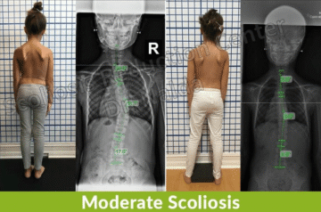 هل يمكن للطفل المصاب باعوجاج العمود الفقري أن يعيش حياة طبيعية؟