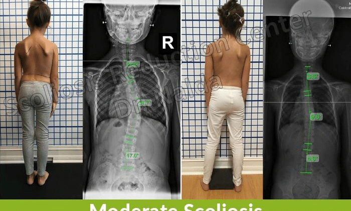 هل يمكن للطفل المصاب باعوجاج العمود الفقري أن يعيش حياة طبيعية؟